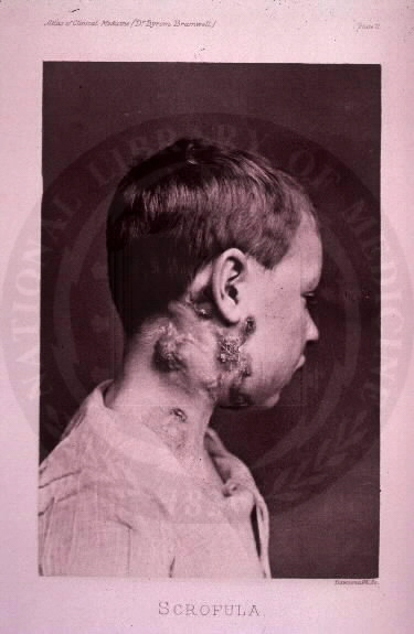 Malato di scrofolosi